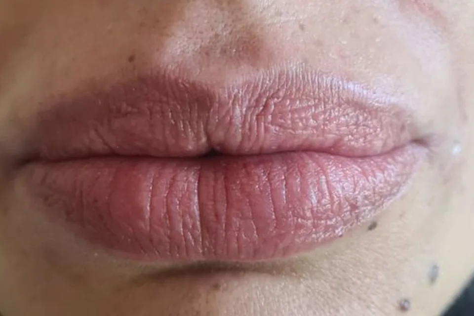 Filler labbra, dopo il trattamento