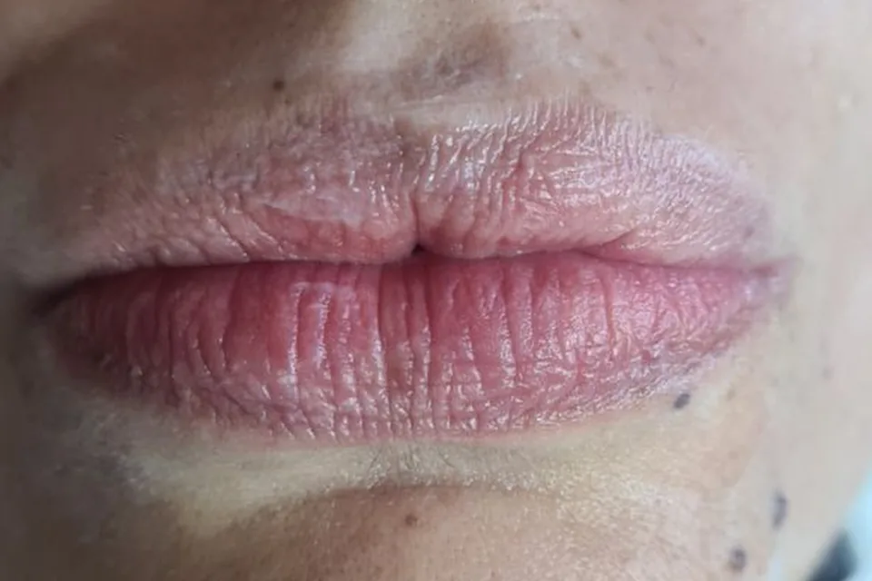 Filler labbra, prima del trattamento