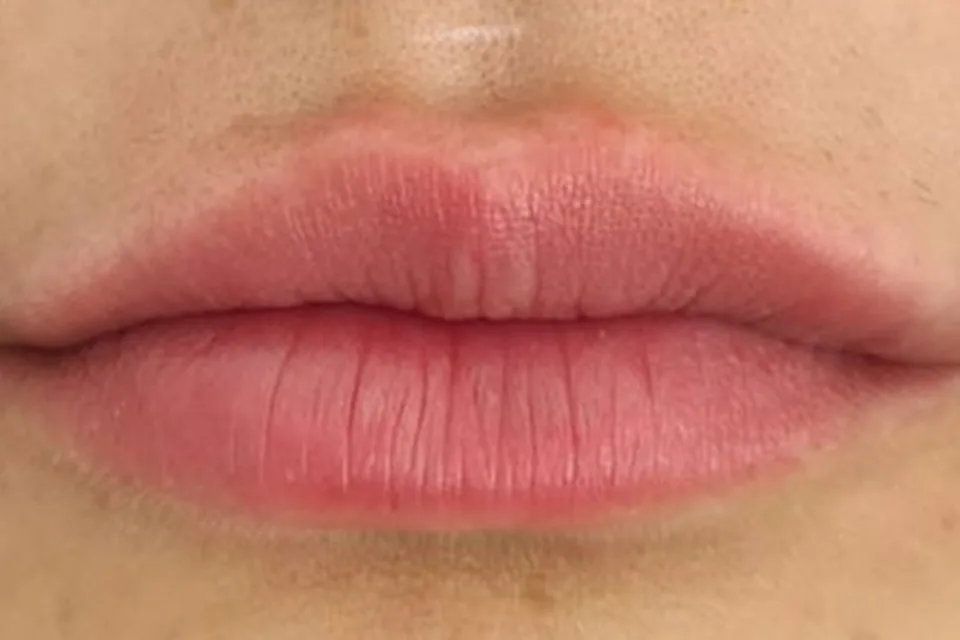 Filler labbra, dopo il trattamento