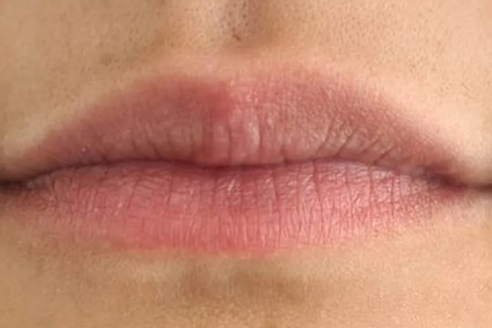 Filler labbra, prima del trattamento